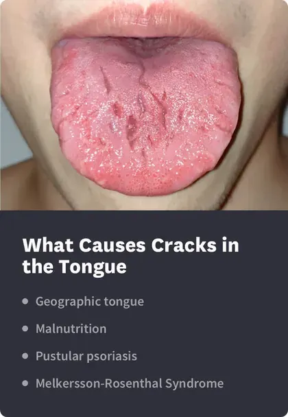 Causes of Cracks in Tongue