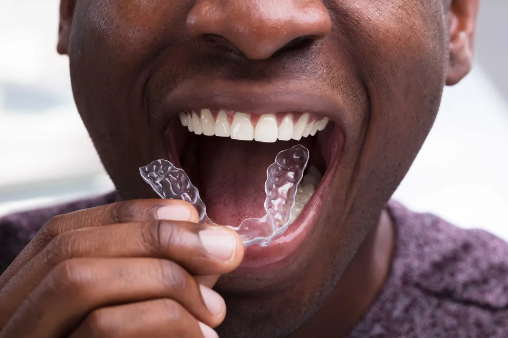 Invisible Braces And Aligners: Types & Comparisons | Byte® | Byte®