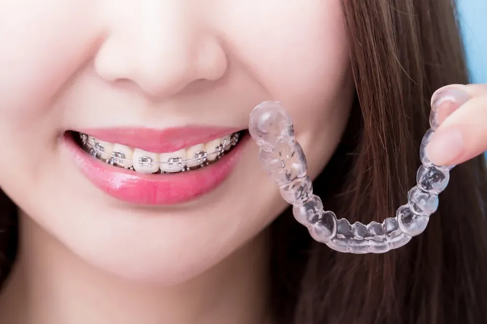 straighter-teeth-with-braces