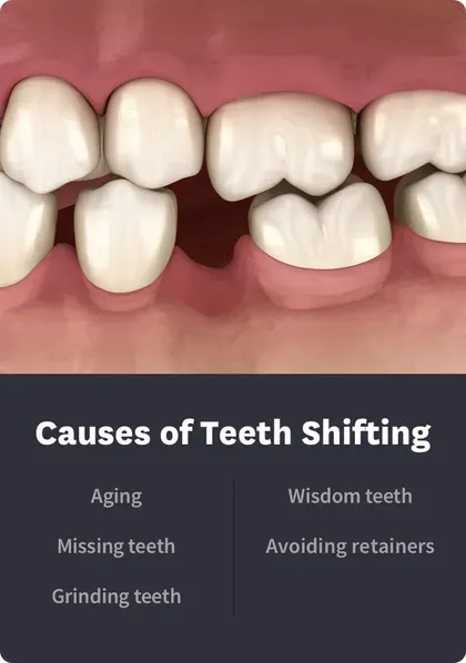 Causes of Teeth Shifting