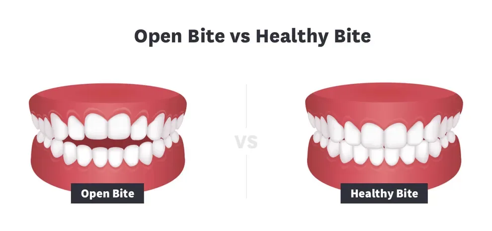 Fixing an Open Bite: Are Braces the Only Answer?, Byte®