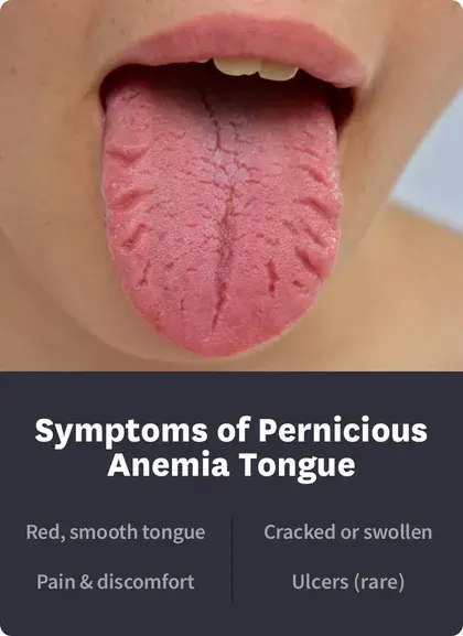 Symptoms of Pernicious Anemia Tongue