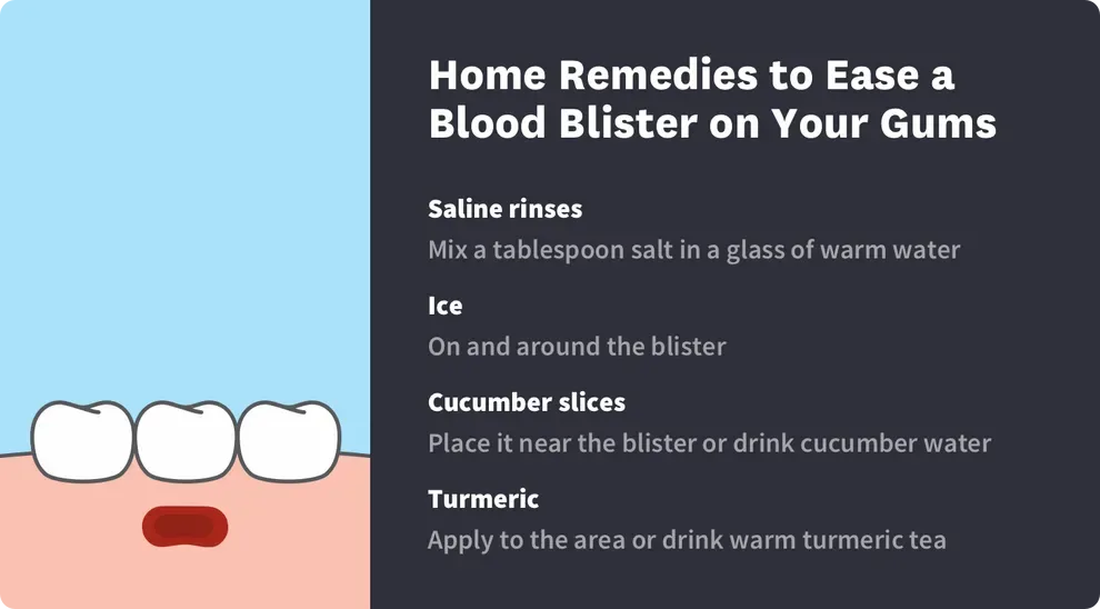 home remedies to ease a blood blister on your gums