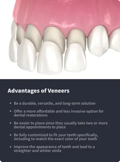 Advantages of Veneers