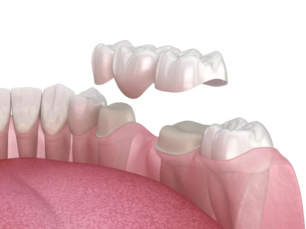 How Much Do Dental Bridges Cost And Why Insurance Helps Byte Byte   Dental Bridges Cost Why Insurance Helps 