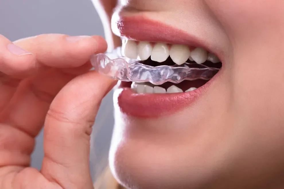 What to Do if Your Retainer Doesn’t Fit Byte®