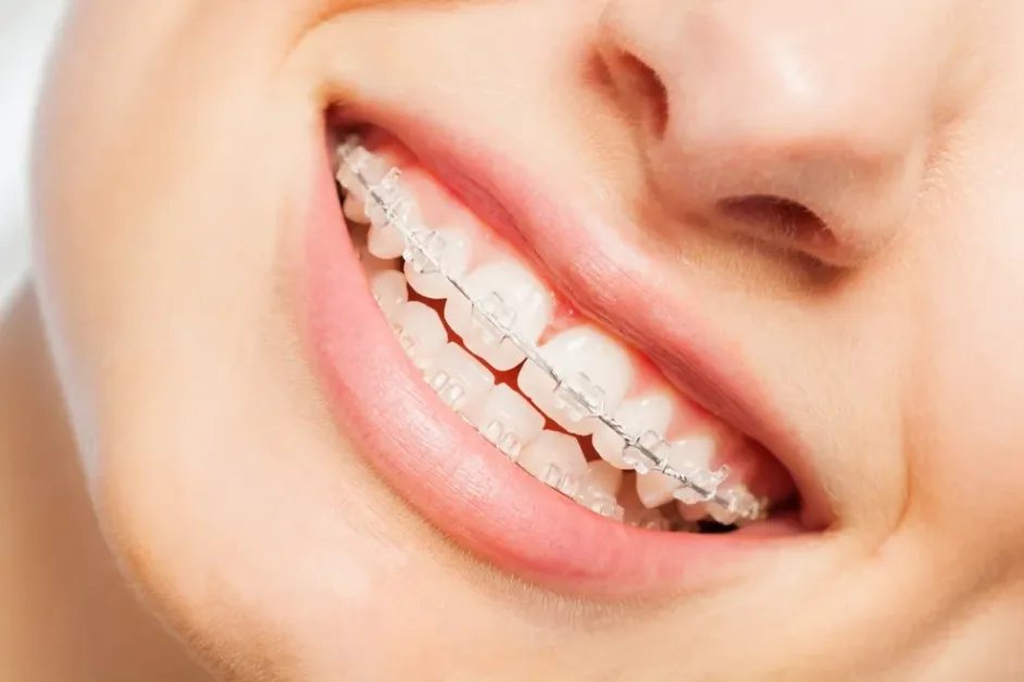 Comparison between metal braces, clear braces and clear aligners