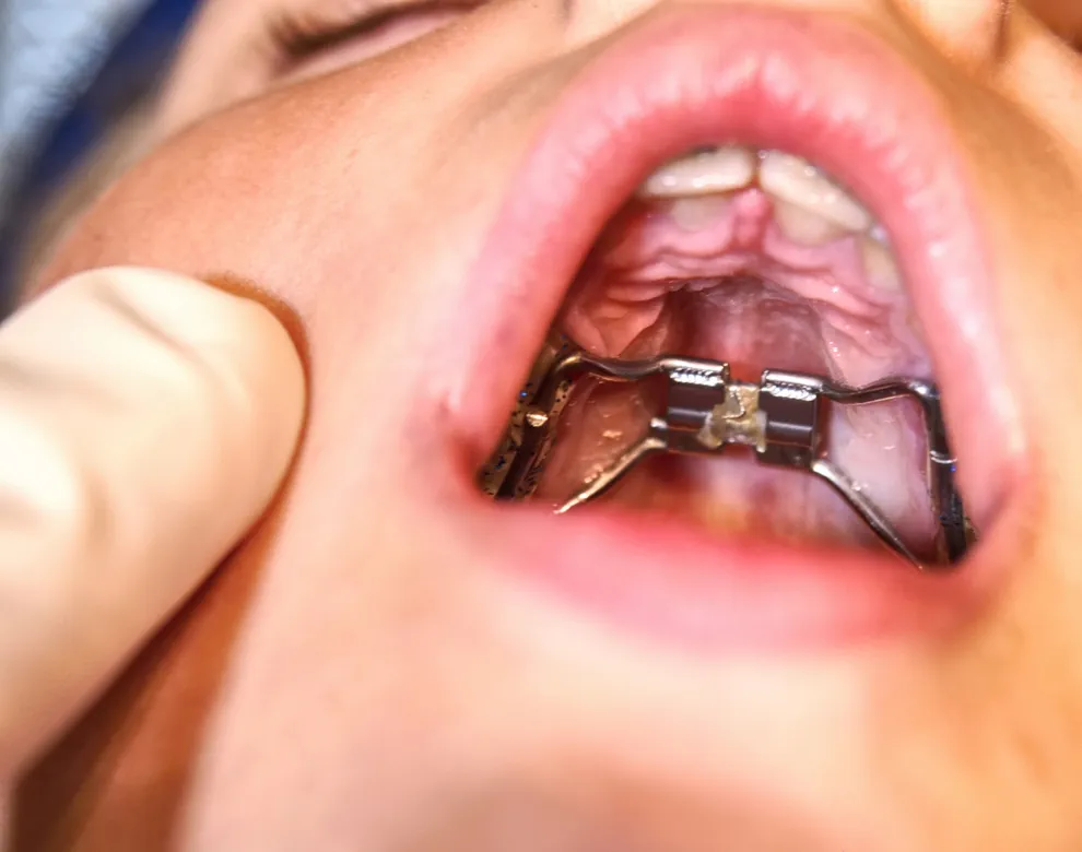 What Is a Palate Expander? Uses, How It Works and More