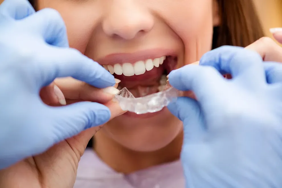 Does clear aligner orthodontic treatment fix an overbite? - Urban Smile