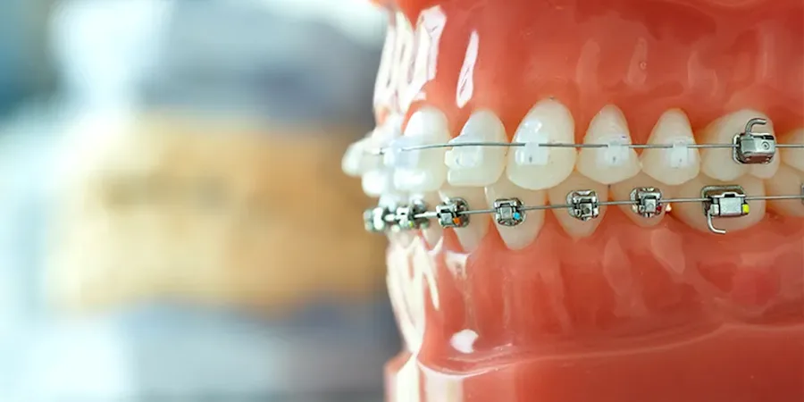 Teeth Alignment Kitchen Ethnicity Teeth Alignement β How To Find Ethnicity By Face β FKTFUW
