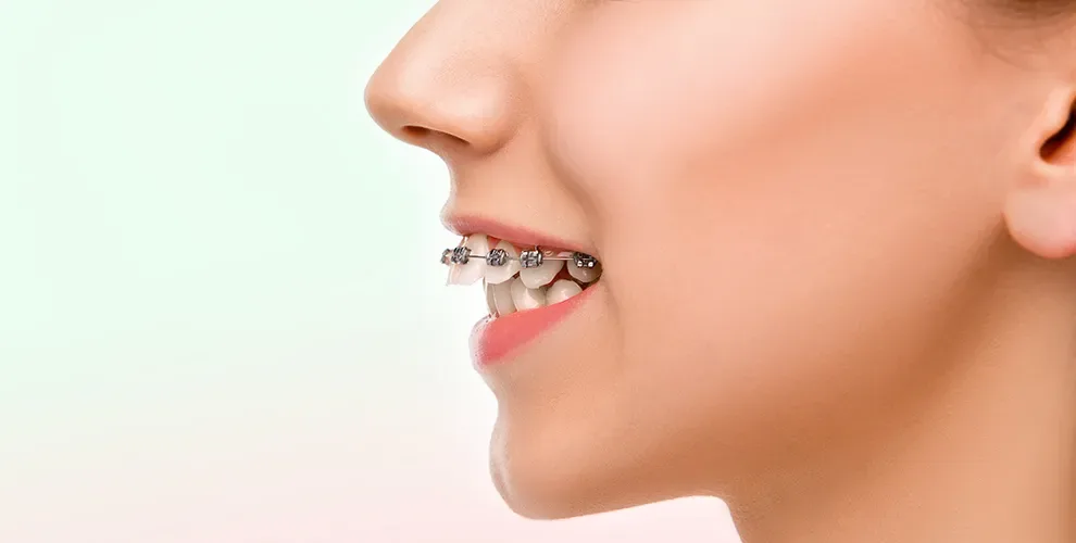 03_how-to-fix-an-unsightly-overbite-for-good