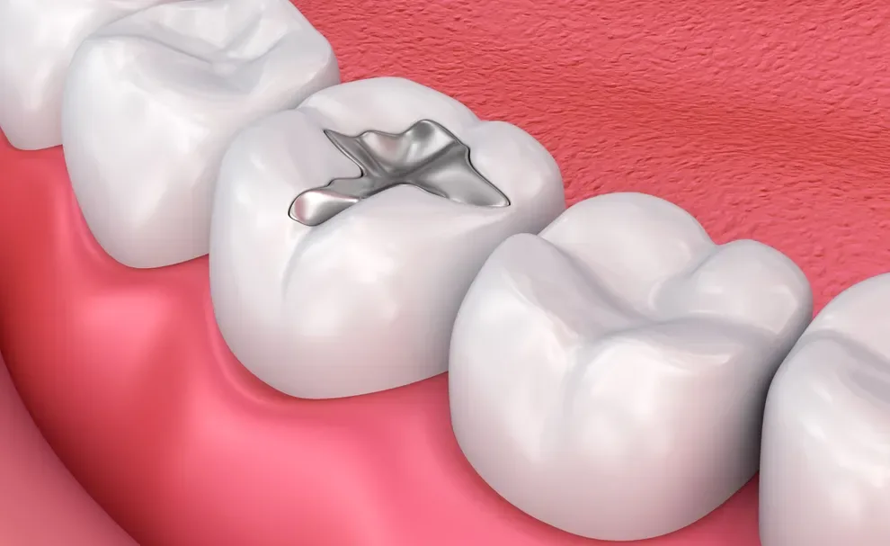 cavity-filling-costs-in-2021