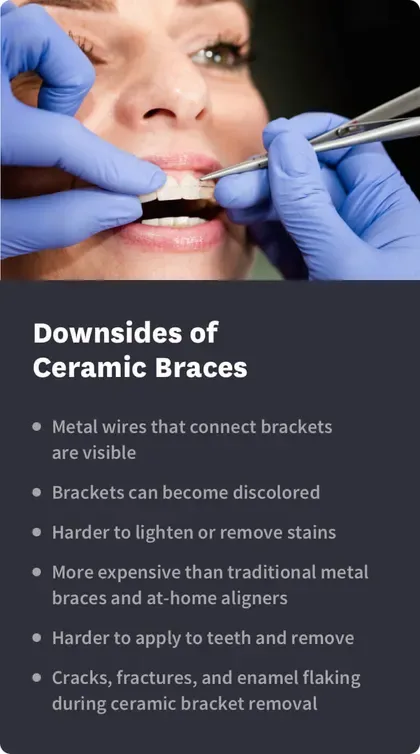 Ceramic Braces, Advantages, Costs & More
