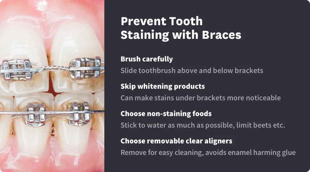 How to Prevent Tooth Staining with Braces