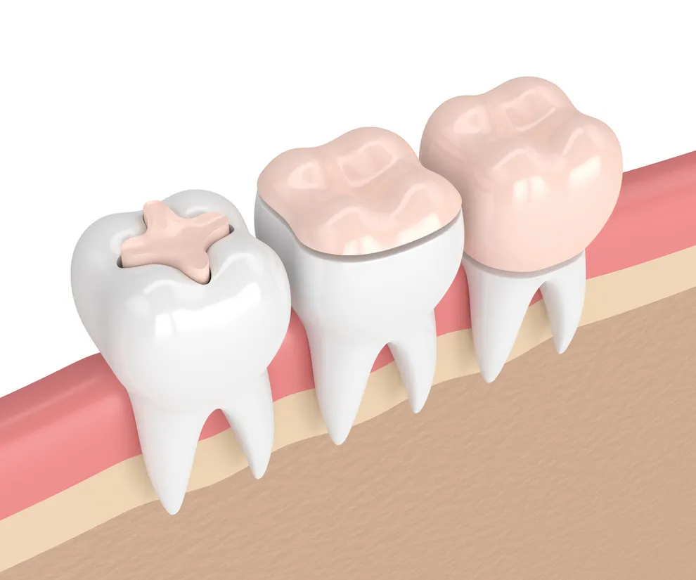 Tooth inlay deals