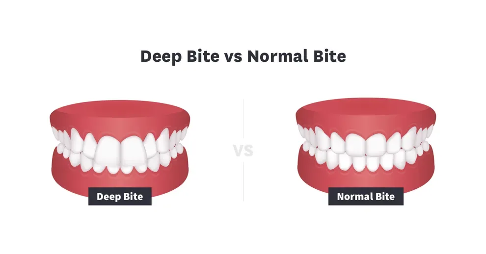 What Does It Mean If You Have A Deep Bite? How To Fix It Byte®