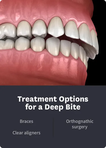 Deep bite: when does it exist & treatment
