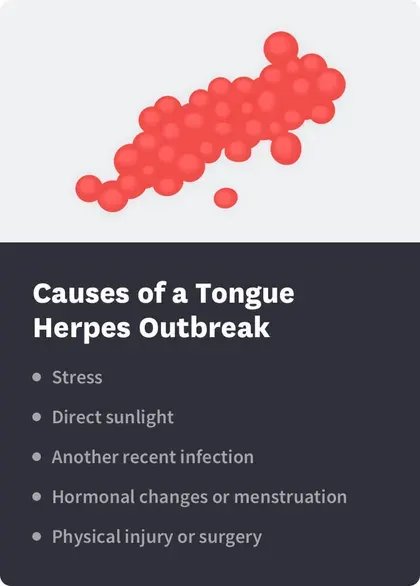 Causes of Tongue Herpes Outbreak