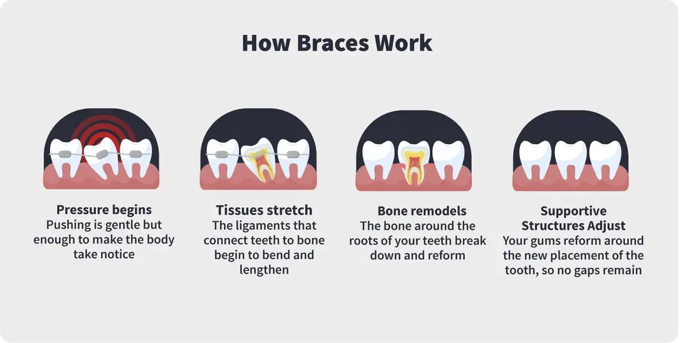 how braces work