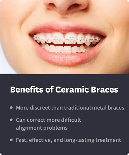 Benefits of Ceramic Braces