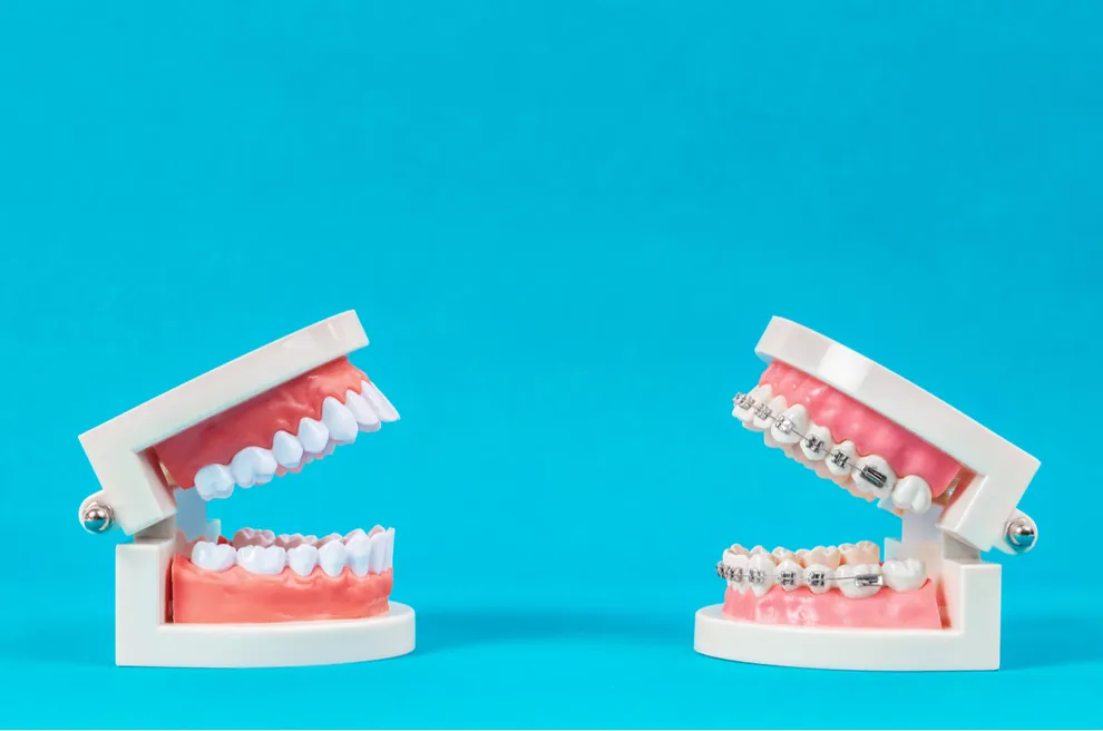 Are Braces and Aligners Cheaper in Other Countries? Byte®
