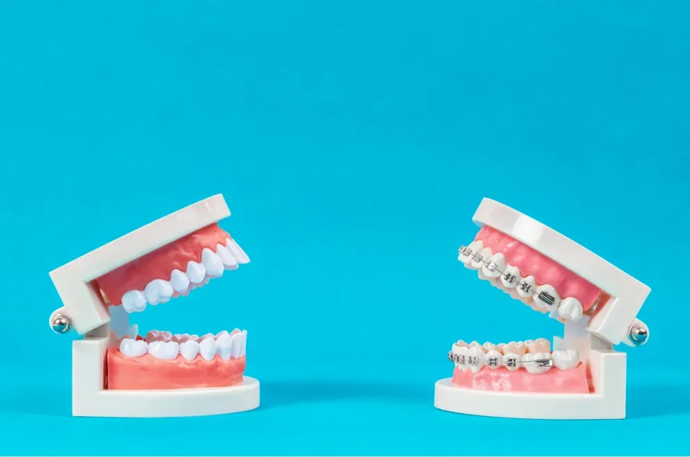 Are Braces and Aligners Cheaper in Other Countries?