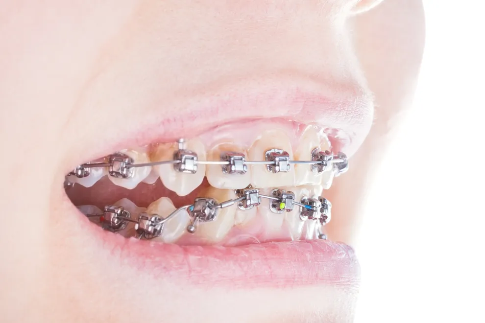 Learn About Braces - Costs, Side Effects and Options