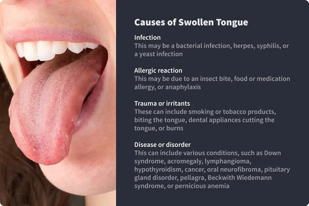causes of swollen tongue