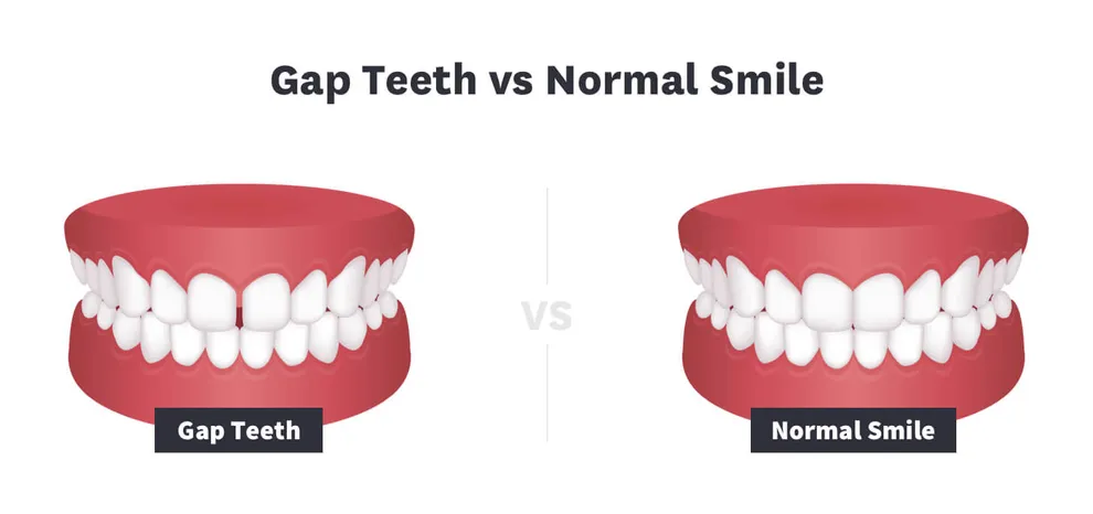 Teeth Before After Braces See the Difference Byte