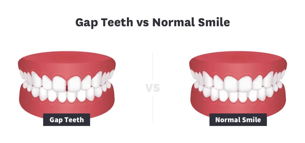 gap teeth vs normal smile
