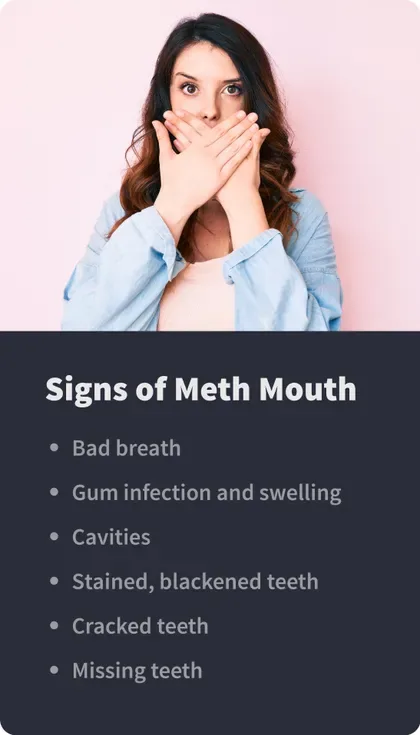 signs of meth mouth