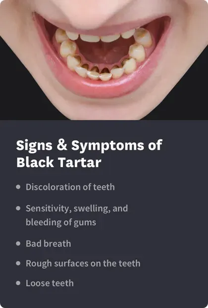 signs and symptoms of black tartar