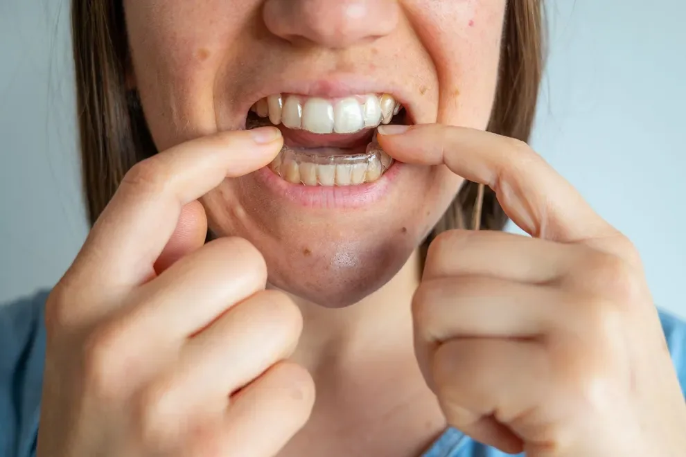 can-i-wear-aligners-if-i-grind-or-clench-my-teeth