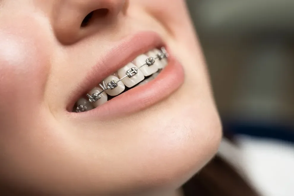 Does Your Invisalign Hurt? Here's How You Can Deal with it.
