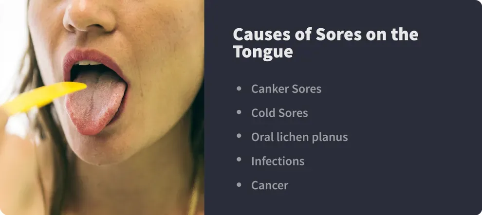 causes of sores on the tongue