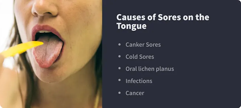 How to Identify & Treat Sores on the Tongue | Byte® | Byte®