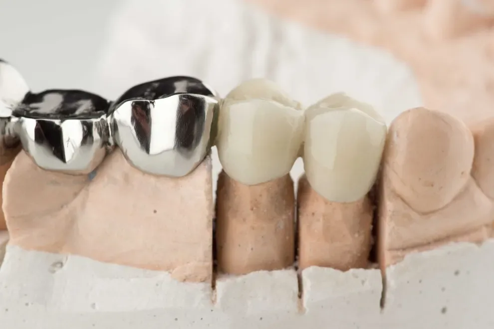 dental-crown-types