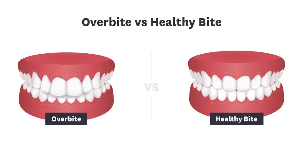 overbite vs healthy bite