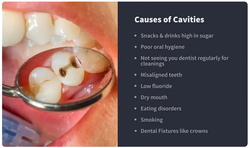 Causes of Cavities