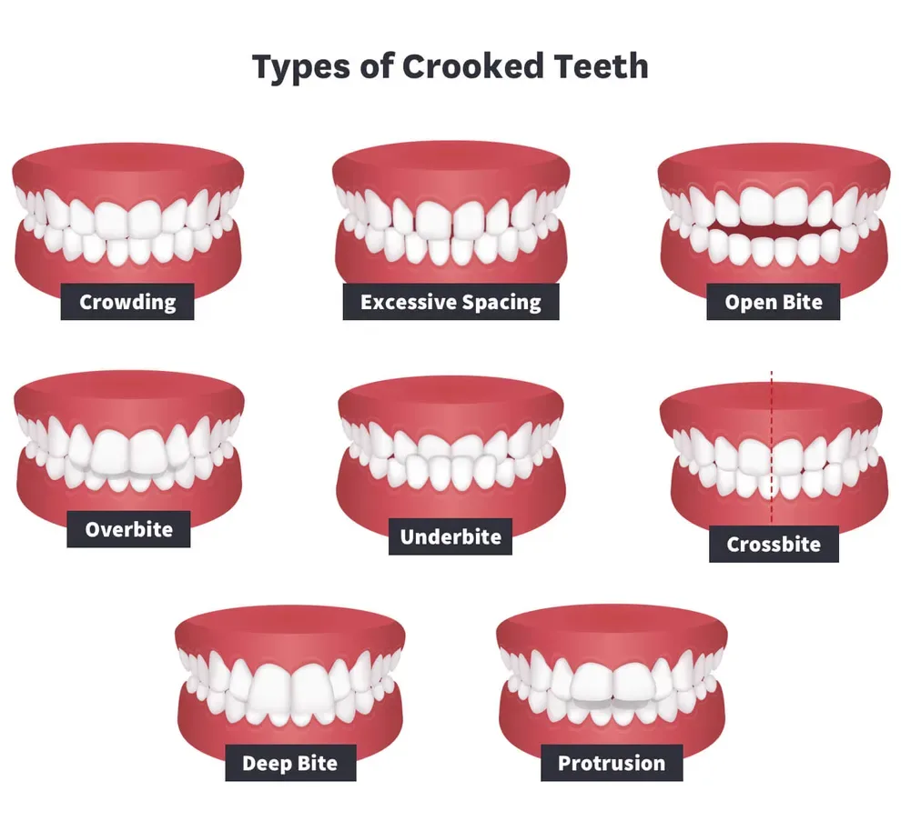 types of crooked teeth