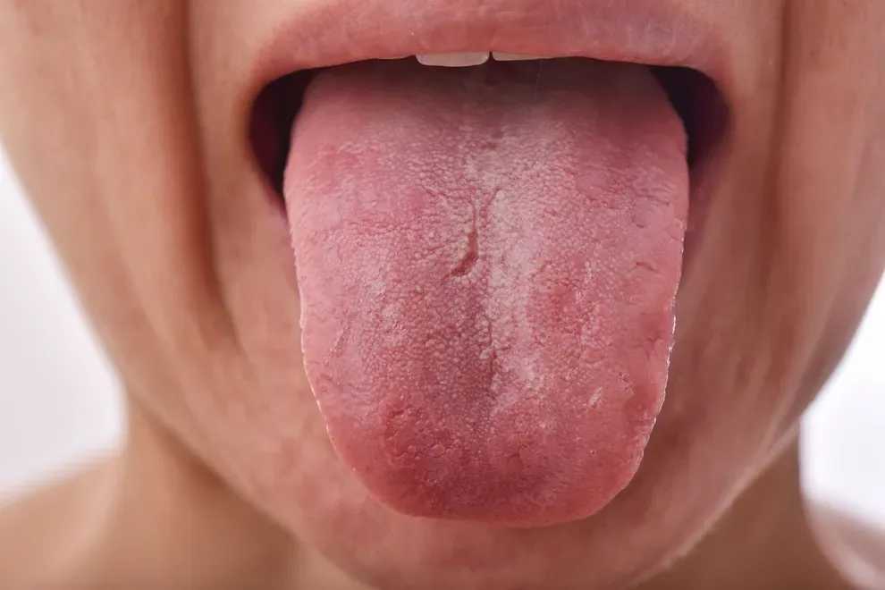 swollen-tongue-common-causes-treatment