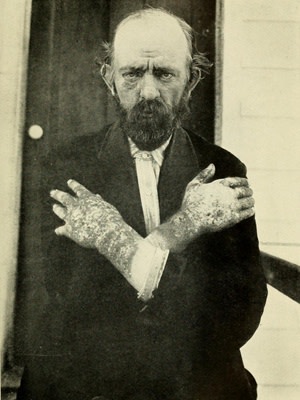 Dermatitis, Pellagra - South Carolina State Board of Health 1909
