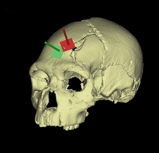 skull fracture sima
