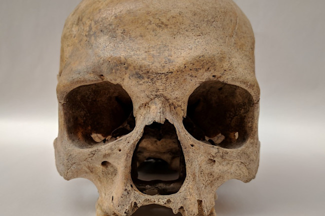 Ancient Genomes Revise The Origins Of Leprosy Discover Magazine