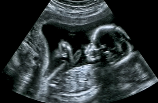 Ultrasound-Fetus.jpg