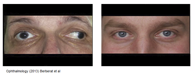 strabismus.png