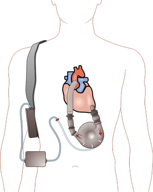 Ventricular_assist_device.gif