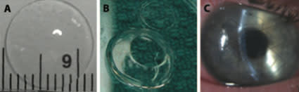 artificial-cornea.jpg