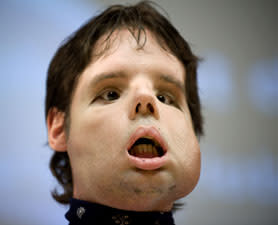 face-transplant-278x225.jpg