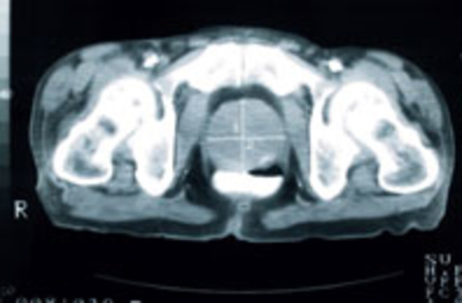 pelvis xray enlarged prostate